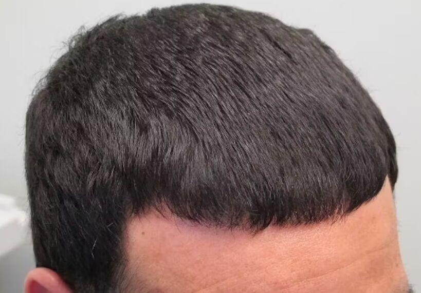 Ich habe Haarausfall Verdoxidil geheilt